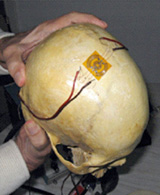 Chip e seu sensor de deformação de dimensões no crânio humano - crédito foto: reprodução Chip e seu sensor de deformação de dimensões no crânio humano - crédito foto: reprodução
