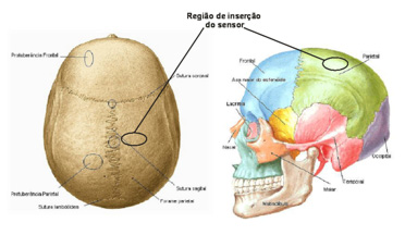 Ilustração mostra o local de instalação do sensor que mede a pressão intracraniana - crédito foto: reprodução Ilustração mostra o local de instalação do sensor que mede a pressão intracraniana - crédito foto: reprodução