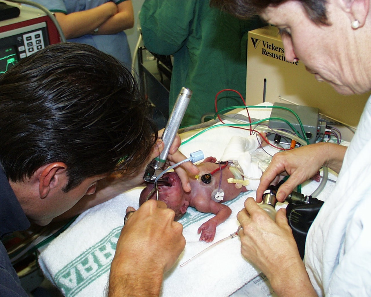 Intubation of a premature newborn with respiratory failure