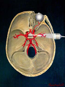 Transcranial Doppler