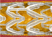 Abbott's bioabsorbable drug eluting stent